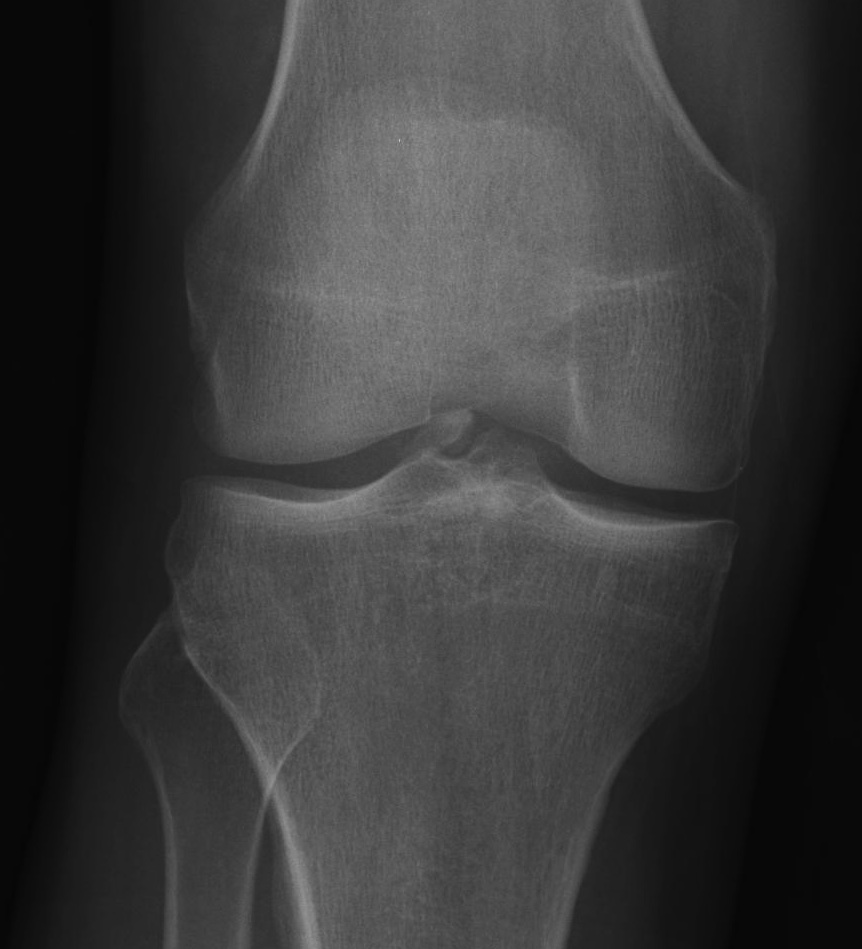 PCL Avulsion 2